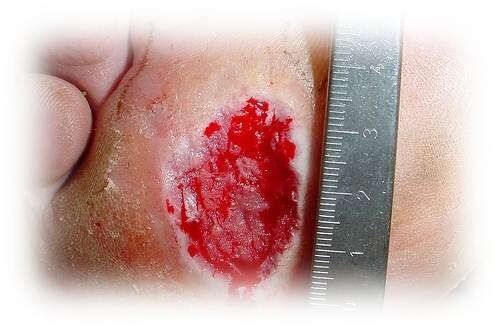 Diabetic Ulcer Wounds