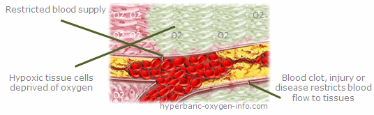 tissue hypoxia, what is hypoxia, hypoxic tissue